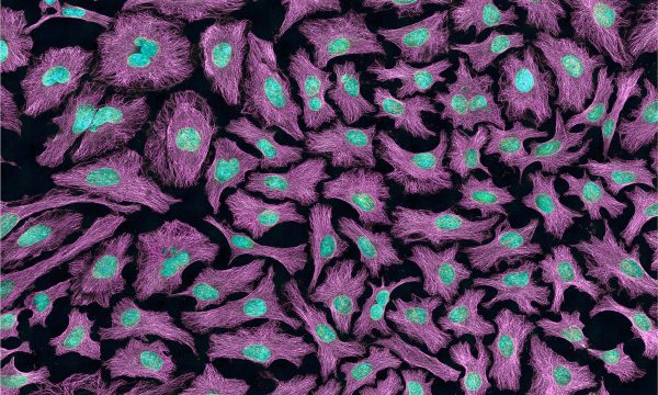 What is Hansen’s disease?